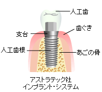 インプラント治療