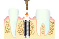 インプラント治療