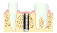 インプラント治療