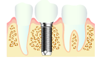 インプラント治療