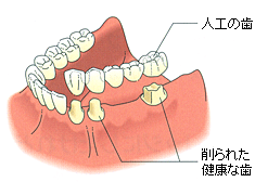 両隣の歯を削って人工の歯をかぶせます