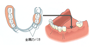 両隣の歯を削って人工の歯をかぶせます