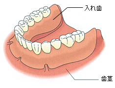 人工の歯（入れ歯）を歯茎全体にかぶせます