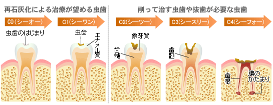 虫歯の進行