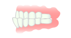 反対咬合（下顎前突）